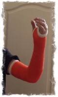 Ulnar head replacement surgery Dec 2013